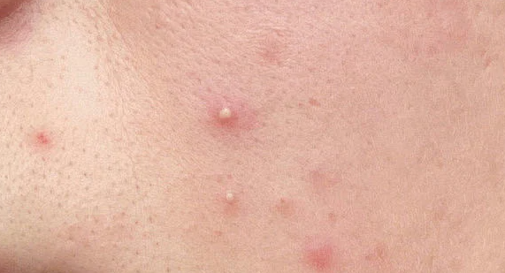 近年来祛痘类功效护肤品发展如何？